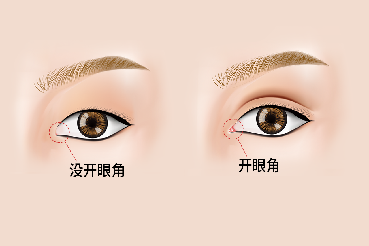 最新开眼角技术，重塑眼部魅力的秘密武器揭秘